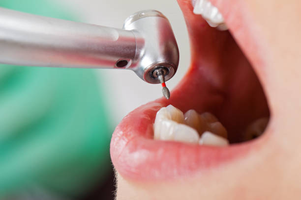 Best Dentist for Tooth Abscess  in North Judson, IN